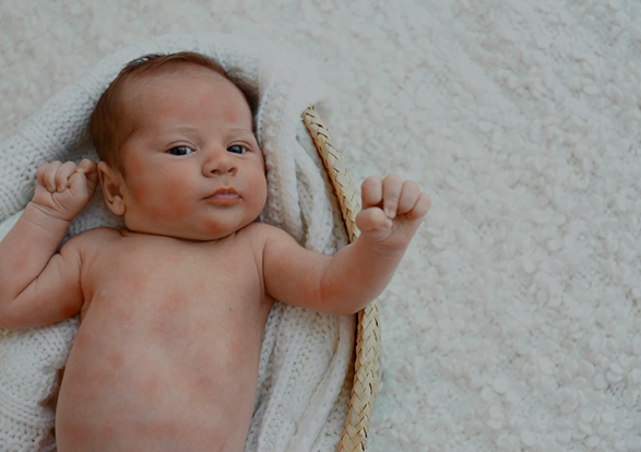 Few week old baby covered in an eczema like rash lying in a moses's basket on a white knit blanket with a white fluffy blanket underneath. 